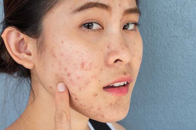 Ini Lho Kandungan Skincare Yang Cocok Untuk Bruntusan