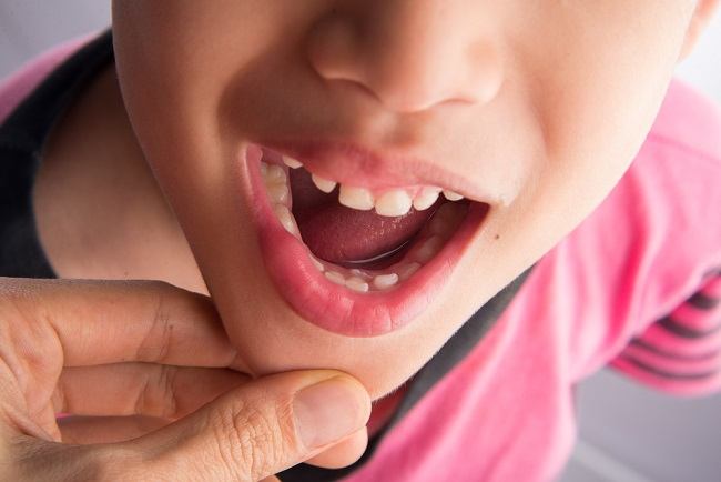 Cara Mengatasi Panas Dalam pada Anak dengan Bahan yang Ada di Rumah (Foto/Alodokter)