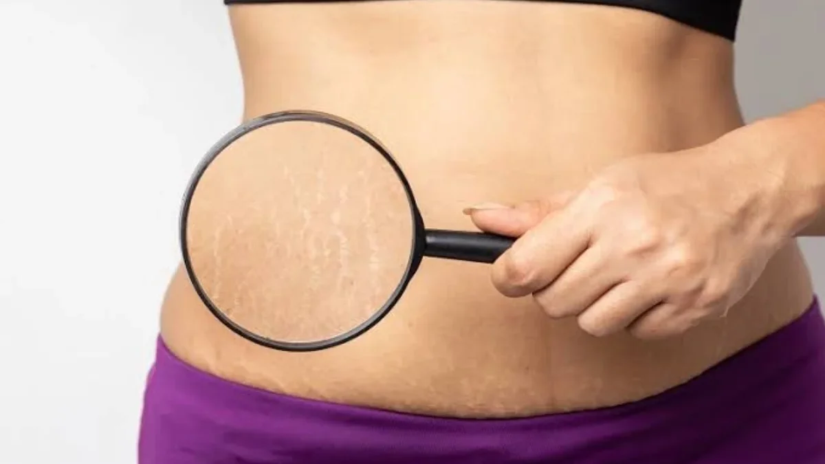 Menghilangkan stretch mark