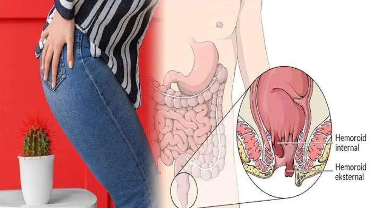 Cara Mengatasi Ambeien atau Wasir