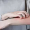 Kenapa Kita Ikut Merasa Gatal Saat Orang Lain Menggaruk