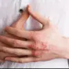 Penyebab jari pecah-pecah.