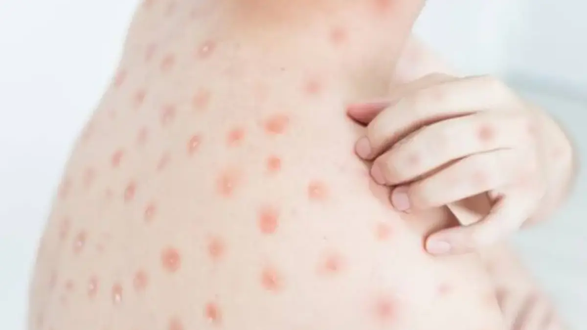 Ganggu Penampilan Gegara Bekas Cacar Air? Coba Gunakan 6 Cara Ampuh Ini Cara Ampuh menghilangkan bekas Cacar Air