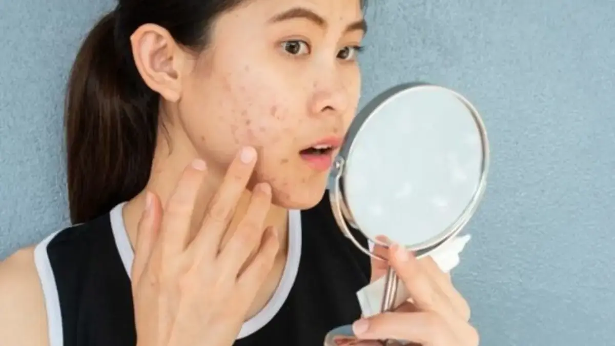 Cara Merawat Kulit Berjerawat untuk Pemula, Tips Praktis dan Produk Aman Buat Kamu! Cara Merawat Kulit Berjerawat untuk Pemula