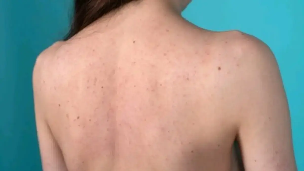 MENJENGKELKAN dan Tak Sedap DIpandang, Inilah 6 Cara Mengatasi Jerawat di Bagian Punggung Ist