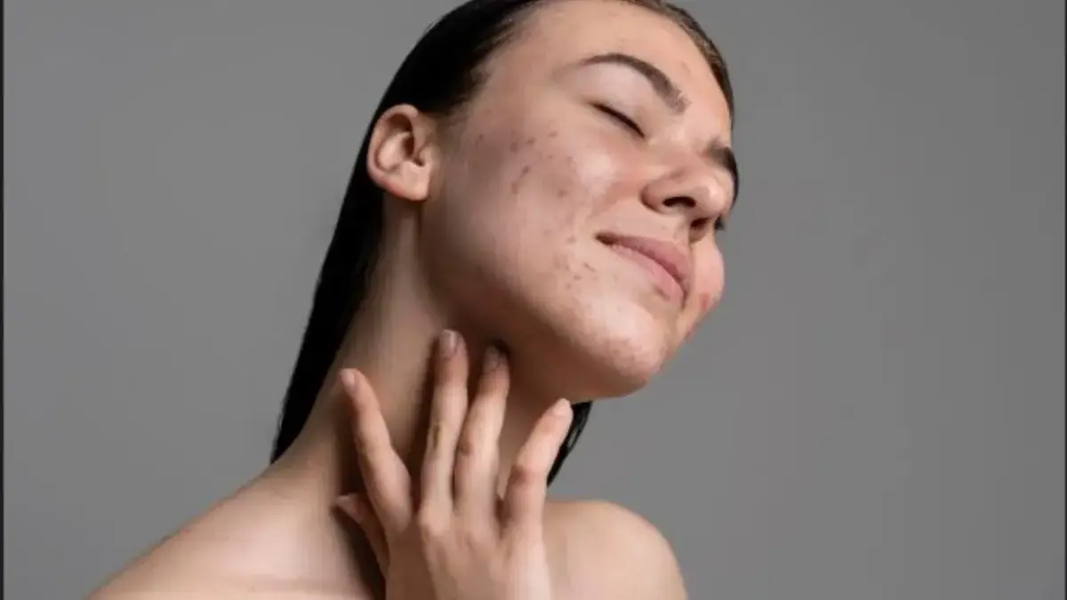 8 Cara Ampuh Menghilangkan Bopeng Bekas Jerawat di Wajah Bopeng Bekas Jerawat