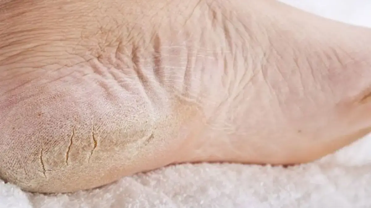 Lima Tips Ampuh Menghilangkan Pecah-pecah pada Kaki yang Wajib Kamu Ketahui! Pecah-pecah pada Kaki