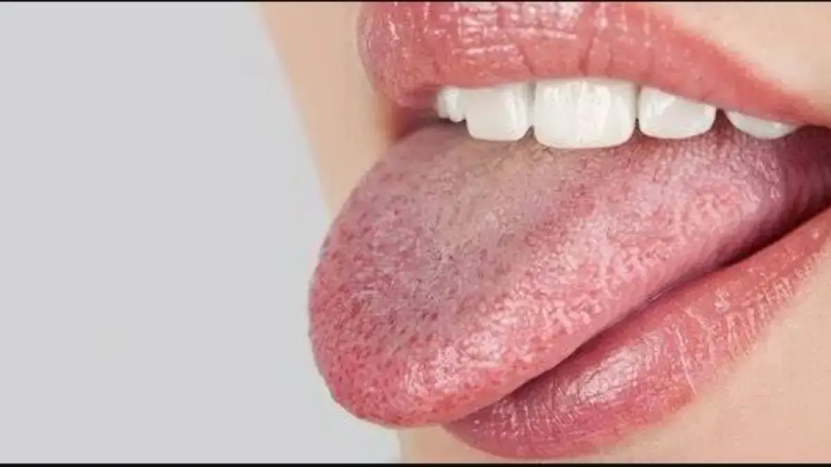 Lidah Kebas Gegara Makan-Makanan Panas? Berikut Tips Cara Menghilangkanya, Simak! Tips Mengatasi Lidah Kebas Akibat Makanan Panas