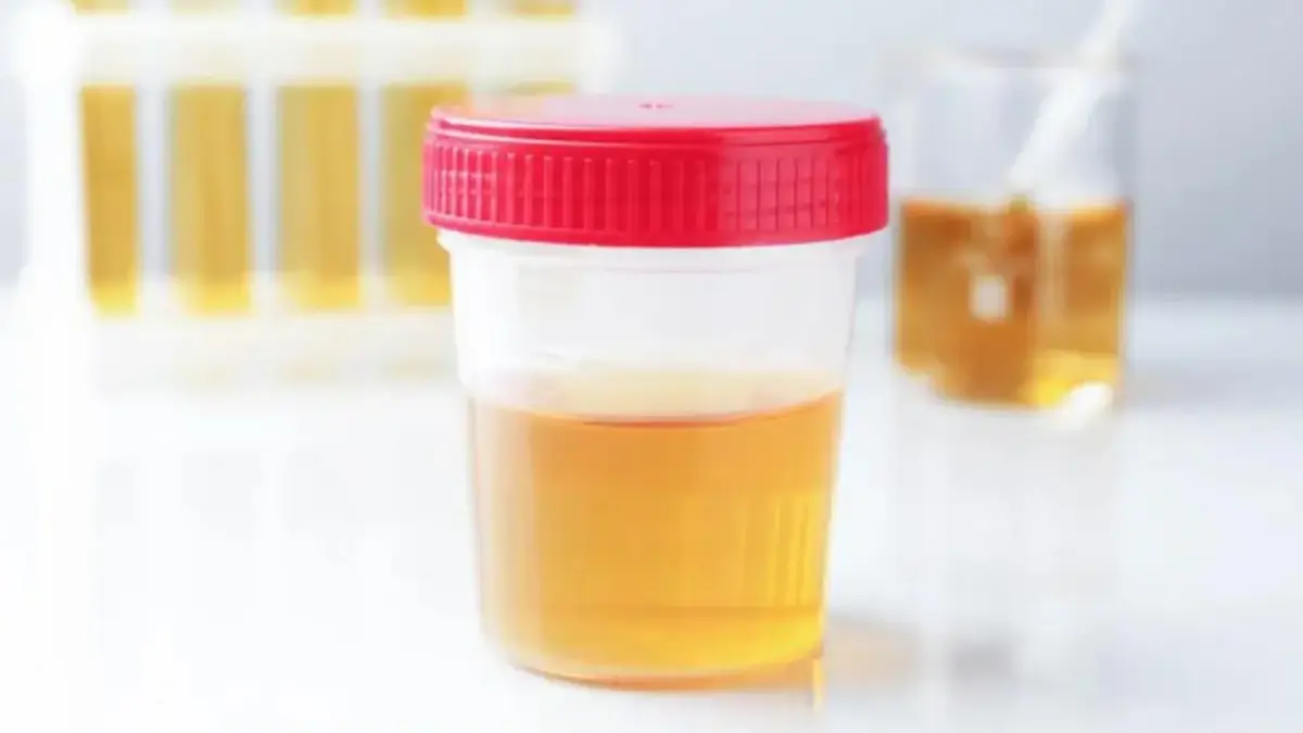 Urine Berwarna Pekat Saat Puasa, Bahaya atau Normal? Ini Penjelasan Lengkap Dokter Urine Berwarna Pekat Saat Puasa, Bahaya atau Normal?