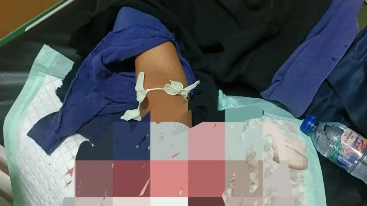 Tawuran Pecah di Karawang, Tangan Remaja Nyaris Putus Ditebas Sajam Tangan remaja nyaris putus gegara tawuran